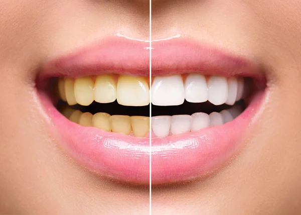 Dientes de mujer antes y después del blanqueamiento . — Foto de Stock