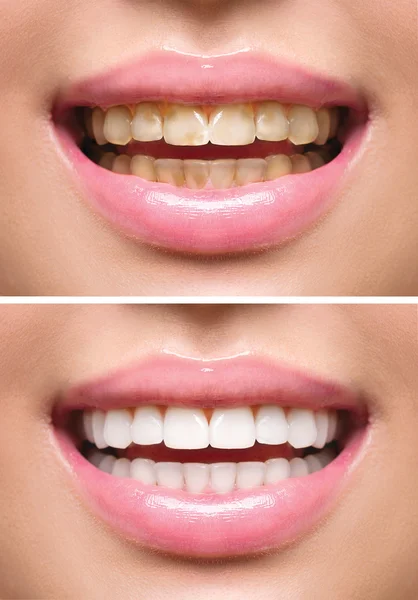 Dientes de mujer antes y después del blanqueamiento . — Foto de Stock