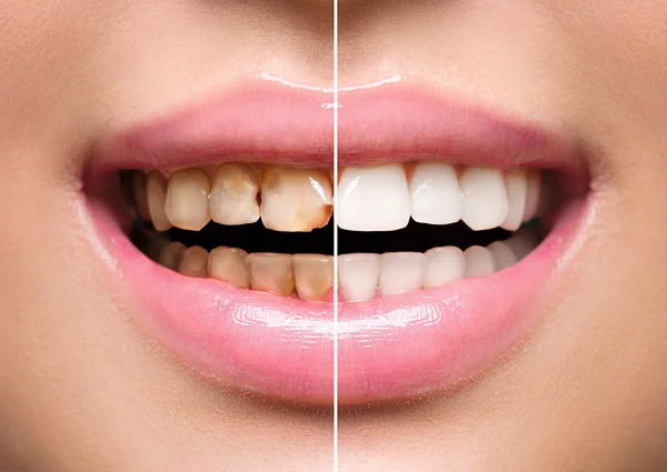 Женские зубы до и после отбеливания . — стоковое фото