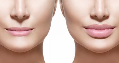 Before and after lip filler injections. clipart
