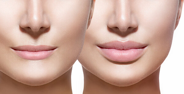 Before and after lip filler injections.