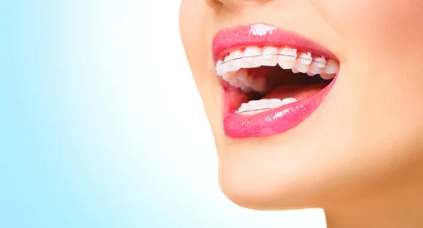 Beautiful woman with ceramic braces — Stock Photo, Image