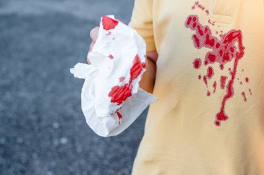 Sarı bir çocuk tişörtündeki kan lekesini kapat. Burun kanamaları alerjik rhinitis, hava yolu veya burun yaralanması, kaza kanaması
