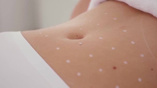 Vrouwelijke buik met littekens — Stockvideo