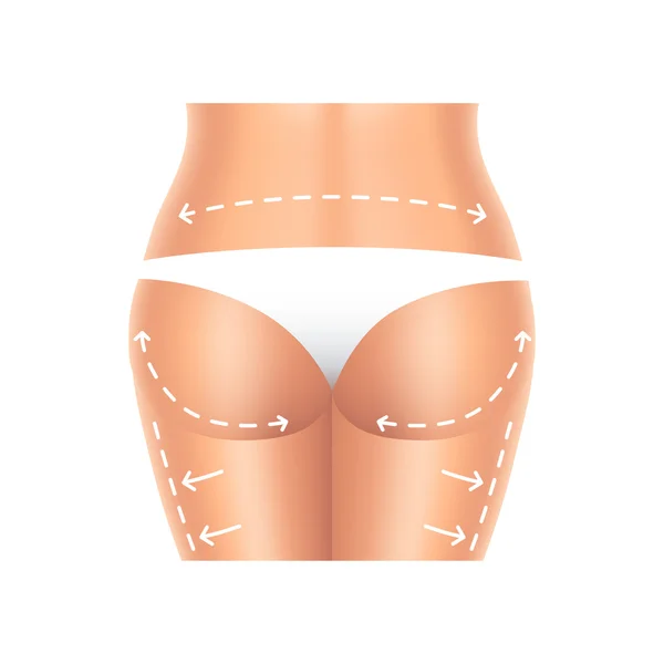 Chirurgie plastique fesses et jambes isolées vecteur — Image vectorielle