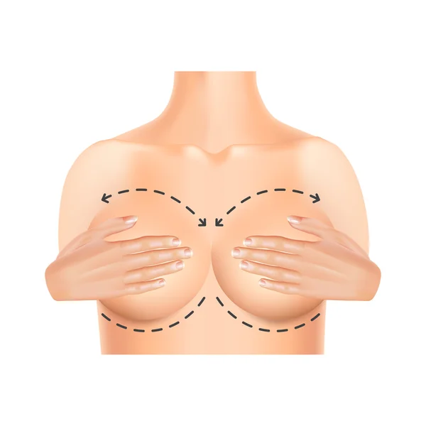 Plastic surgery breast isolated on white vector — Stock Vector
