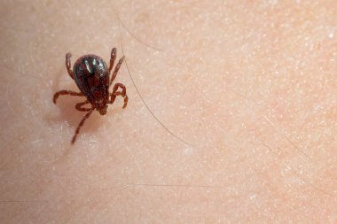İnsan derisi üzerinde sürünen kahverengi köpek kenesi. Parazitler, beyin iltihabı, lyme hastalığı, anaplazmoz, babezi, aşı ve sağlık konseptleri.