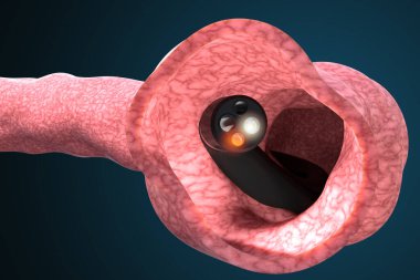 Bağırsakların durumunu kontrol etmek ve gastrointestinal hastalıkları tespit etmek için tıbbi cihaz. Kolonoskopi ve gastroskopi tıbbi teşhisi. 3d illüstrasyon