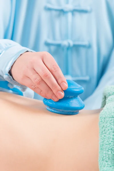 Chinese cupping therapy — Stock Photo, Image