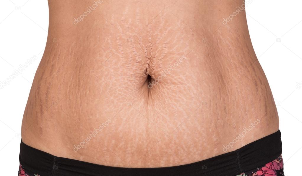 Woman showing stretch marks.