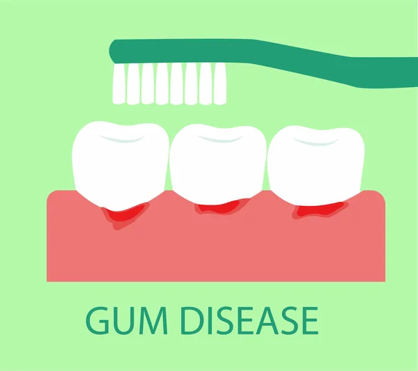 Brushing Teeth Prevent Gum Disease — Stock Vector