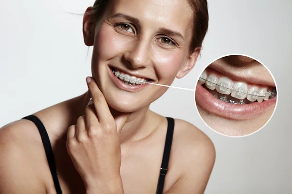 Menina com suportes dentários — Fotografia de Stock