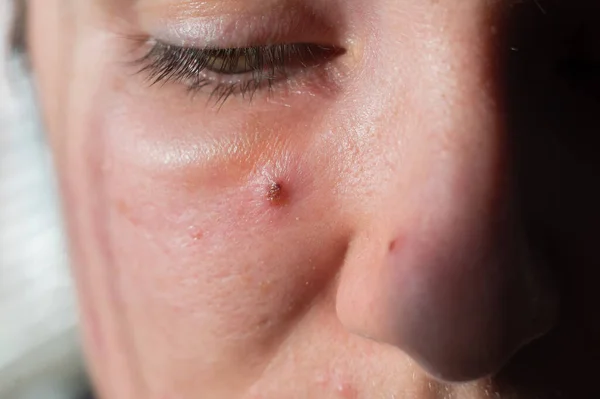 Acne em uma cara de mulher de perto. Retrato de uma mulher com pele problemática — Fotografia de Stock