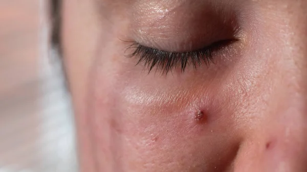 Acne em uma cara de mulher de perto. Retrato de uma mulher com pele problemática — Fotografia de Stock