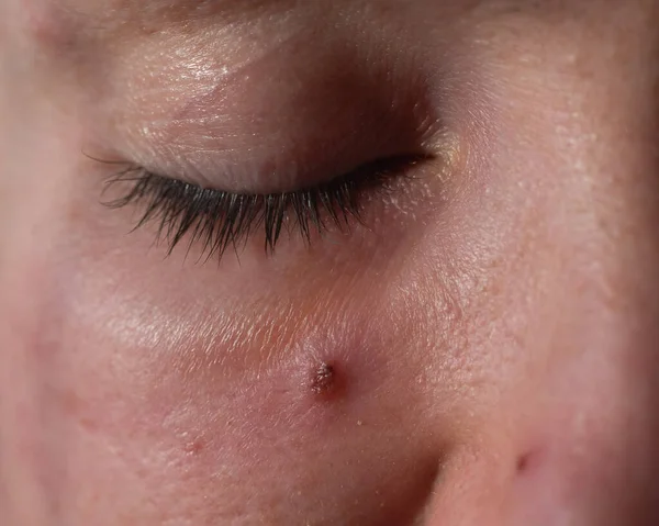 L'acne su una faccia di donne da vicino. Ritratto di donna con pelle problematica — Foto Stock