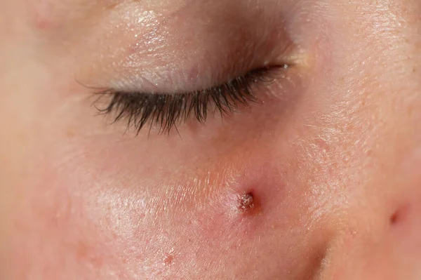 Acne em uma cara de mulher de perto. Retrato de uma mulher com pele problemática — Fotografia de Stock