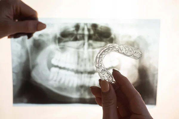 Mains féminines avec protège-dents transparents pour corriger les morsures et les radiographies de la mâchoire. L'orthodontiste tient l'équipement de l'orthodontiste — Photo