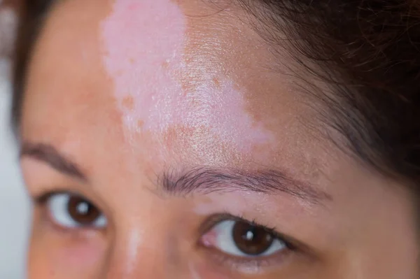 Close-up de uma mulher com doença de pigmentação auto-imune vitiligo — Fotografia de Stock
