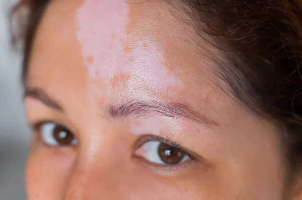 Close-up de uma mulher com doença de pigmentação auto-imune vitiligo — Fotografia de Stock