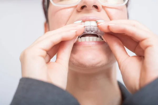 Primo piano di una donna che indossa fermi in plastica trasparente. La ragazza usa un dispositivo per raddrizzare i denti — Foto Stock