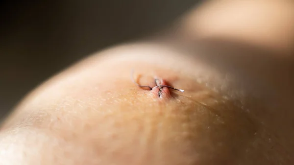 Close-up de uma sutura cirúrgica após cirurgia de menisco laparoscópico. — Fotografia de Stock