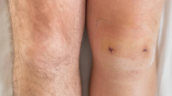 Close-up of a surgical suture on the knee after laparoscopic minisk surgery. Male legs after surgery — Stock Photo, Image