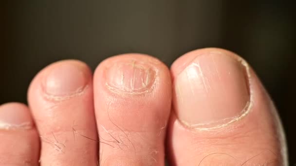 Close-up of male toes with a cracked nail — Stock Video