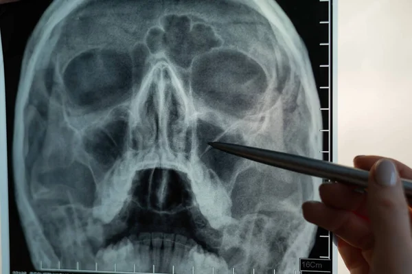 Raios-X da cabeça humana. O médico aponta os sinais de sinusite — Fotografia de Stock