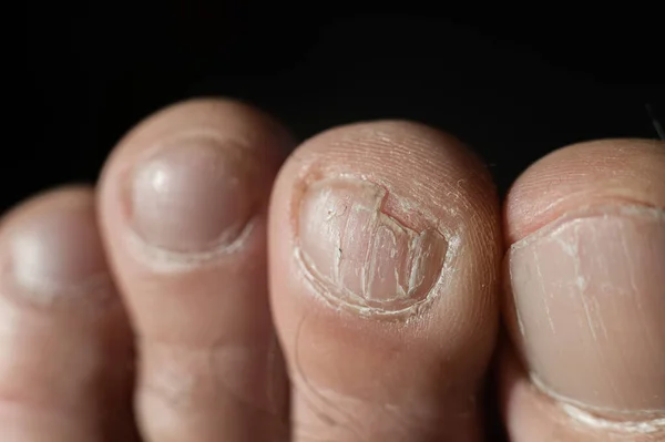 Close-up de dedos masculinos com uma unha rachada — Fotografia de Stock