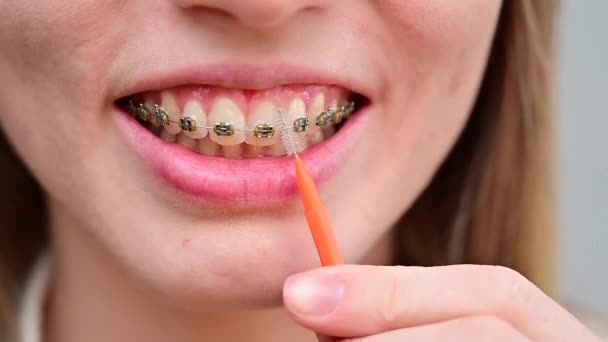 Wanita Kaukasia tak dikenal membersihkan kawat gigi dengan kuas. Close-up gigi perempuan dengan tanda kurung — Stok Video
