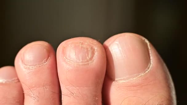 Close-up jari kaki laki-laki dengan kuku retak — Stok Video