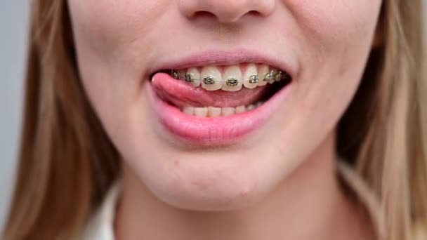 Het onherkenbare roodharige meisje glimlacht en loopt met haar tong over de beugel. Jonge vrouw corrigeert beet met orthodontisch apparaat. — Stockvideo