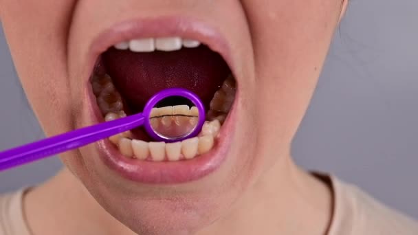 Potret close-up seorang wanita dengan kawat gigi internal dan cermin gigi. Gadis itu mengoreksi gigitan — Stok Video