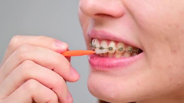 Mujer caucásica irreconocible limpia los aparatos ortopédicos con un cepillo. Primer plano de los dientes femeninos con brackets — Vídeos de Stock