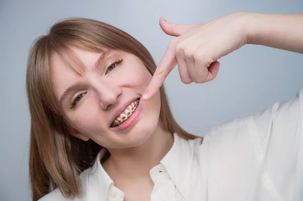 En vacker rödhårig flicka ler och pekar på hängslena. Ung kvinna korrigerar bett med ortodontisk apparat — Stockfoto