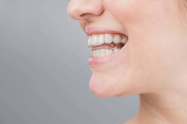 Close-up portrait of a woman with a plastic transparent retainer. A girl corrects a bite with the help of an orthodontic device. Copy space — Stock Photo, Image