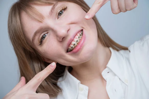 Een prachtig roodharig meisje glimlacht en wijst naar de beugels. Jonge vrouw corrigeert beet met orthodontisch apparaat — Stockfoto