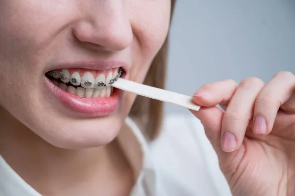 Νεαρή γυναίκα με σιδεράκια στα δόντια μασάει τσίχλα. Το κορίτσι τρώει ζαχαρωτά. — Φωτογραφία Αρχείου