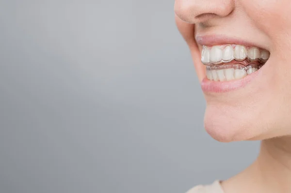 Närbild porträtt av en kvinna med en plast transparent fjädertallrik. En flicka korrigerar ett bett med hjälp av en ortodontisk apparat. Kopiera utrymme — Stockfoto