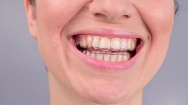 Beyaz kadın portresi gece şeffaf diş telleriyle gülümsüyor. Çıkarılabilir diş telleriyle ısırık düzeltmesi