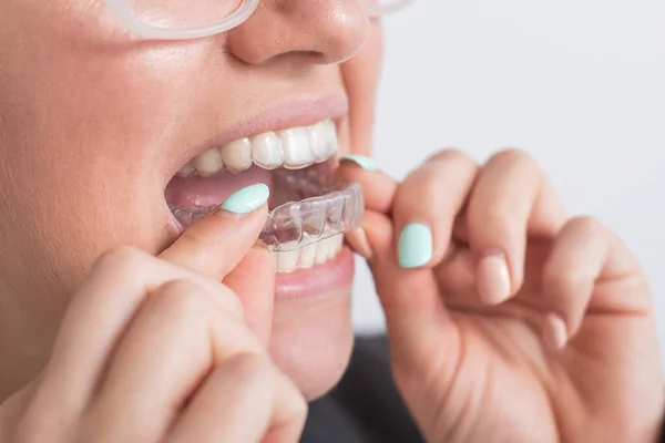 Close-up van een vrouw die doorzichtige plastic beugels opzet. Het meisje gebruikt een apparaat om haar tanden recht te trekken. — Stockfoto