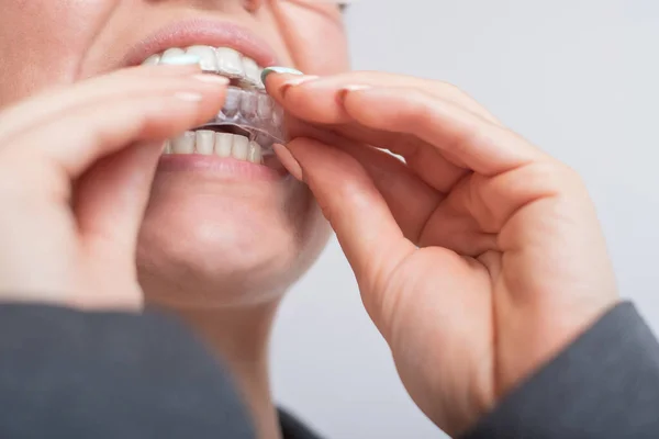 Close-up van een vrouw die doorzichtige plastic beugels opzet. Het meisje gebruikt een apparaat om haar tanden recht te trekken. — Stockfoto