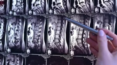 Doktor, bel omurgasının manyetik rezonans görüntülemesi üzerinde çalışıyor.