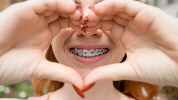 Detailní portrét mladé rusovlasé ženy s rovnátky na zubech, držící ji za ruce ve tvaru srdce. Ortodontické spotřebiče pro dokonalý úsměv. — Stock fotografie