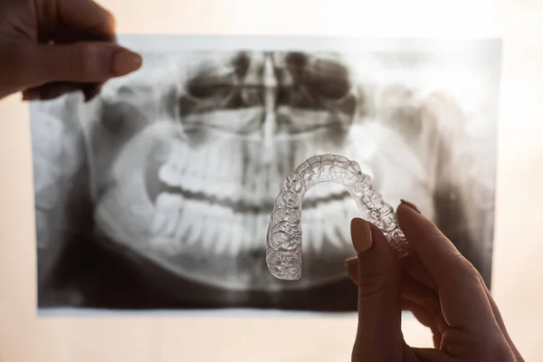 Mãos femininas com protetores de boca transparentes para corrigir mordida e raio-X da mandíbula. O ortodontista detém o equipamento do ortodontista — Fotografia de Stock