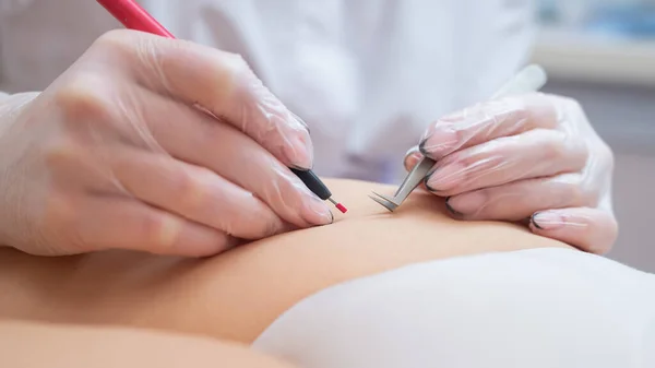 Läkaren gör elektroepilering av bikini zonen till en kvinna i salongen. Ett alternativt sätt att permanent ta bort oönskat kroppshår — Stockfoto