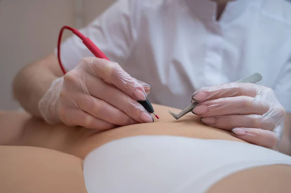 Doktor dělá elektro epilaci bikini zóny ženě v salonu. Alternativní způsob, jak trvale odstranit nežádoucí ochlupení těla — Stock fotografie