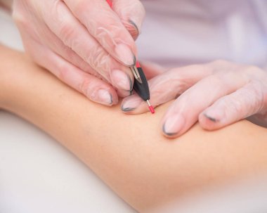 Doktor salondaki kadınların ellerinin elektro epilasyonunu yapıyor. İstenmeyen kılların sonsuza dek alınması için donanıma yakın çekim