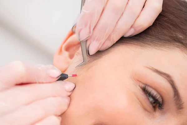 Mulher em electro-epilation do rosto. Hardware remoção permanente de cabelos indesejados no salão — Fotografia de Stock