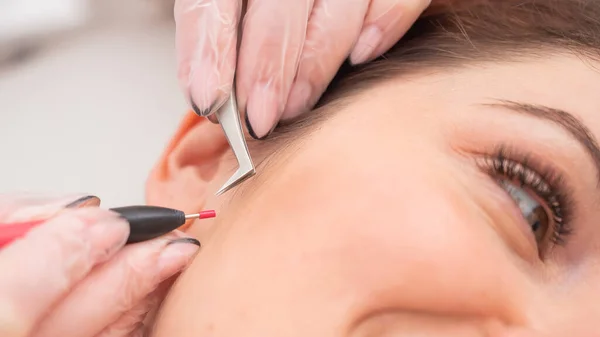 Mujer en electroepiléptica de la cara. Hardware eliminación permanente de cabello no deseado en el salón — Foto de Stock